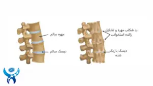 درمان آرتروز ستون فقرات در مشهد