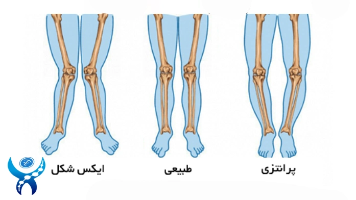 علل ابتلا به زانوی ضربدری