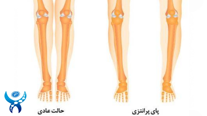 چه افرادی کاندید مناسبی برای جراحی زانوی ضربدری هستند؟